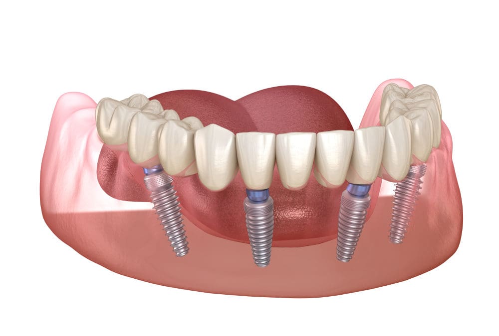 All on 4 – The Permanent Solution to Missing Teeth