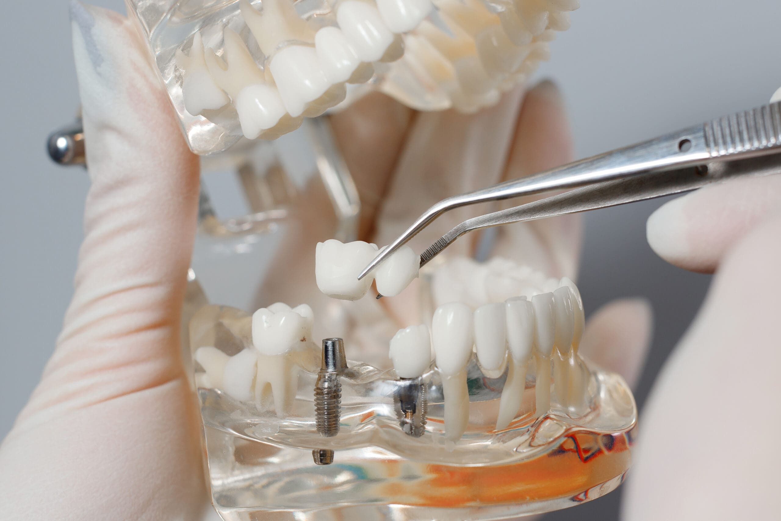 Jaw breadboard. Orthodontist teeth have been capped and stainless pin in gums.