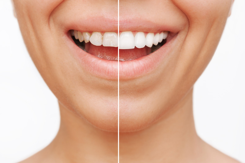 Veneers, Marlton, NJ