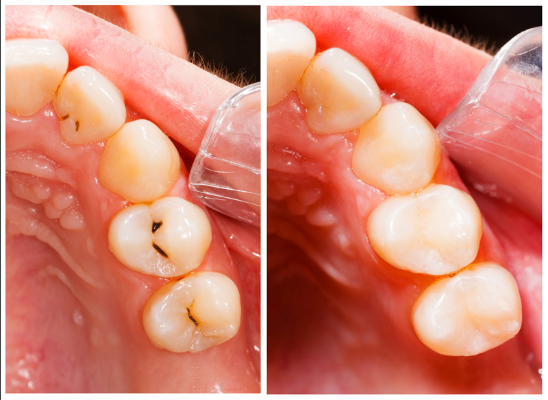 Invisalign, Marlton, NJ