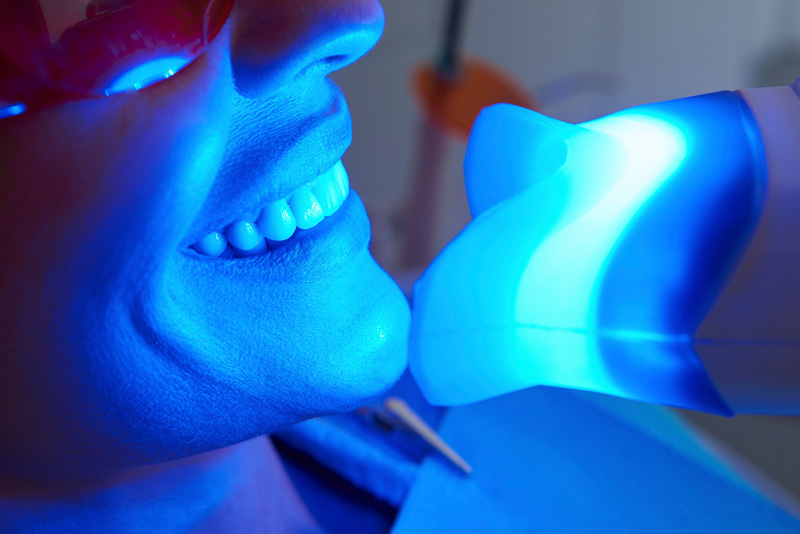 At-home Whitening, Marlton, NJ